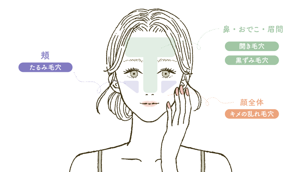 開き毛穴ができやすい部位